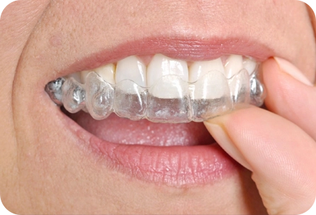 A person is putting their teeth into an invisalign.